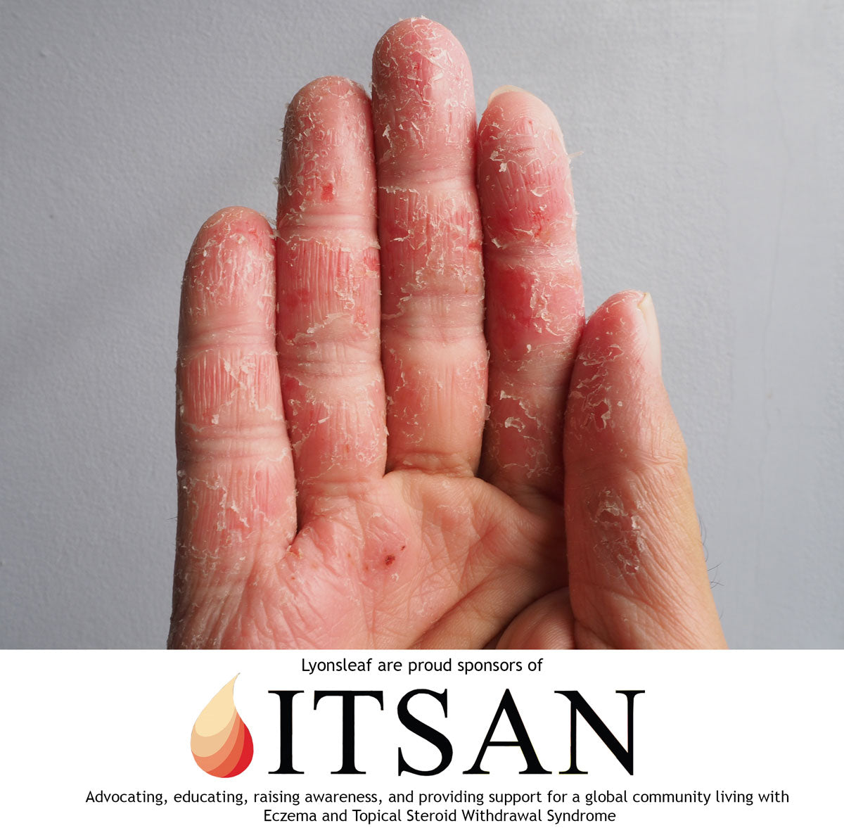 lyonsleaf sponsorship of ITSAN topical steroid withdrawal community, hand with sore, red, flaky skin