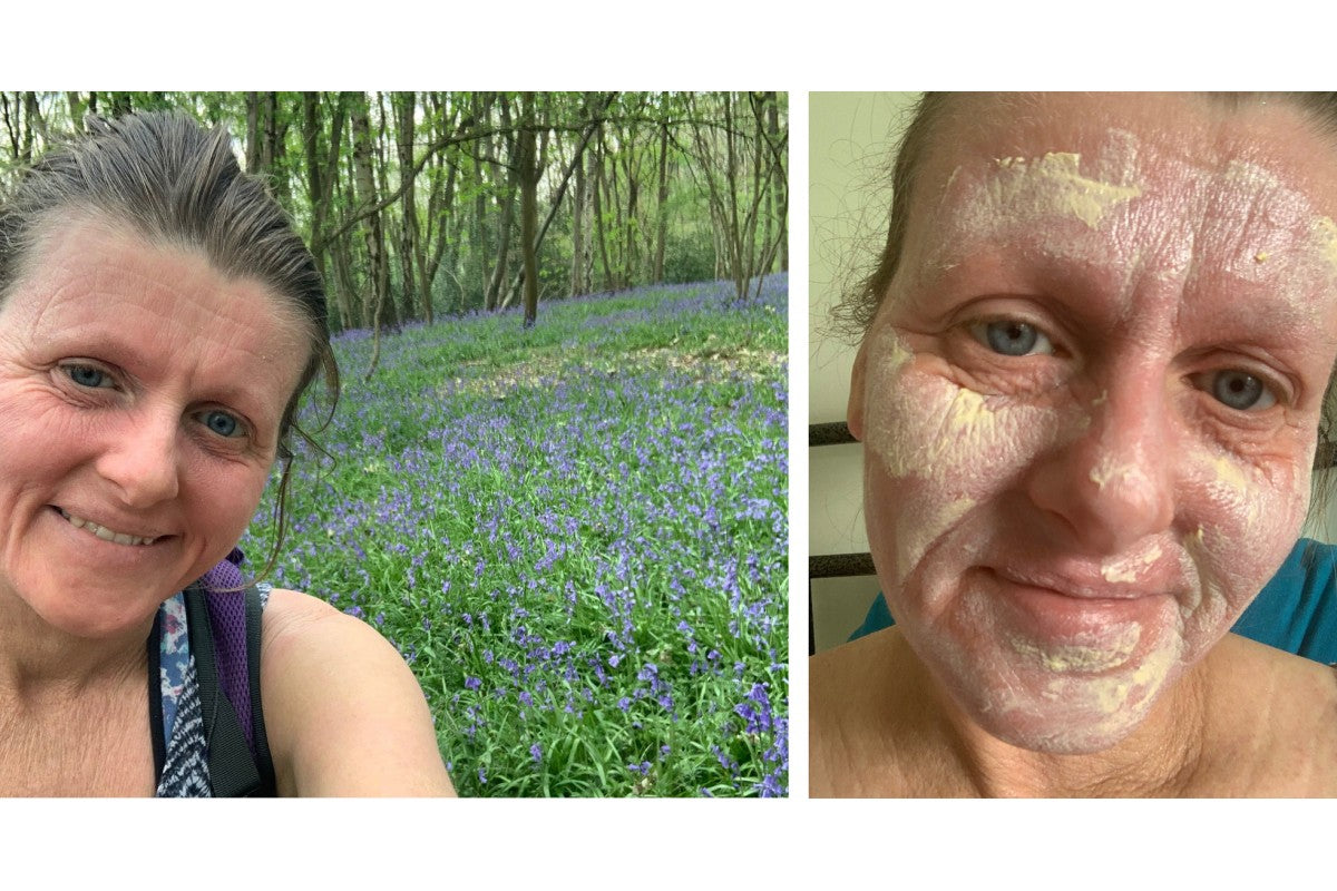 Topical steroid withdrawal and skincare