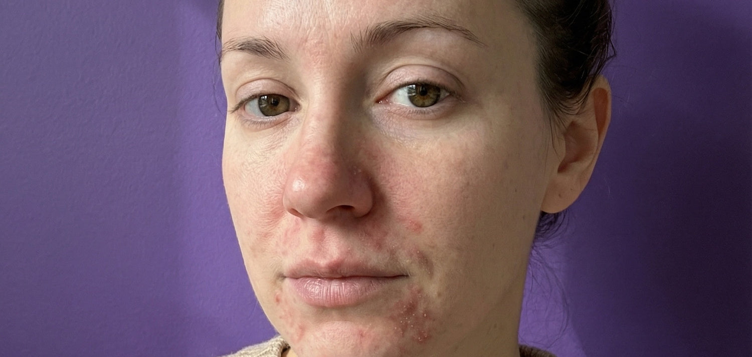 Periorificial Dermatitis rash