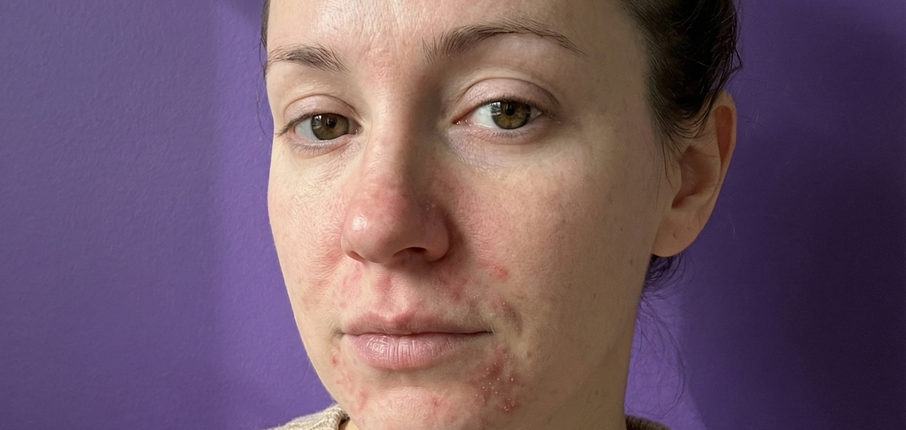 Periorificial Dermatitis rash