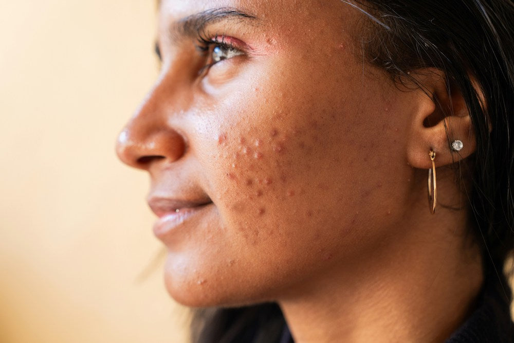 Teenage Skin Care: A Simple Routine for Oily & Blemish-Prone Skin