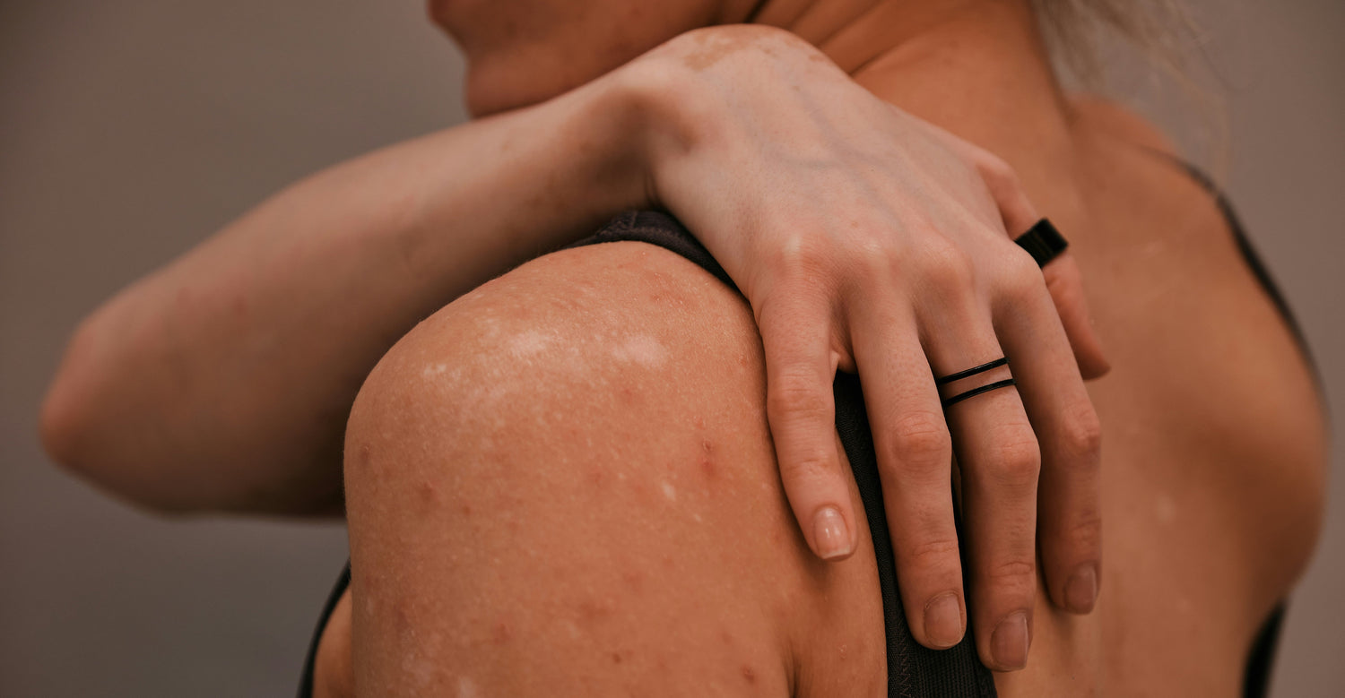 Atopic Dermatitis Treatment
